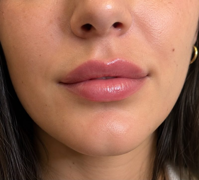 Relleno e hidratación de labios en ValeriCare Sabadell